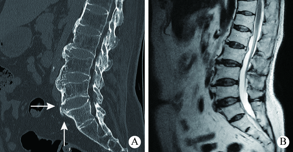 63岁男性，多关节肿痛及腰背部疼痛41年，腰椎骨桥骨折(A：CT平扫；B：MRI)