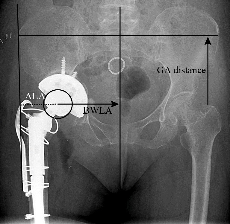 Middle-term outcomes of extended trochanteric osteotomy applied for ...