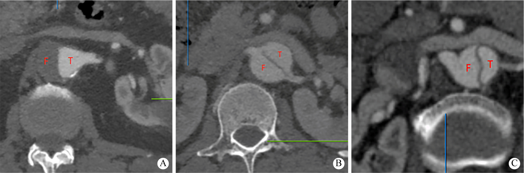 Association between different blood supply forms of renal artery and