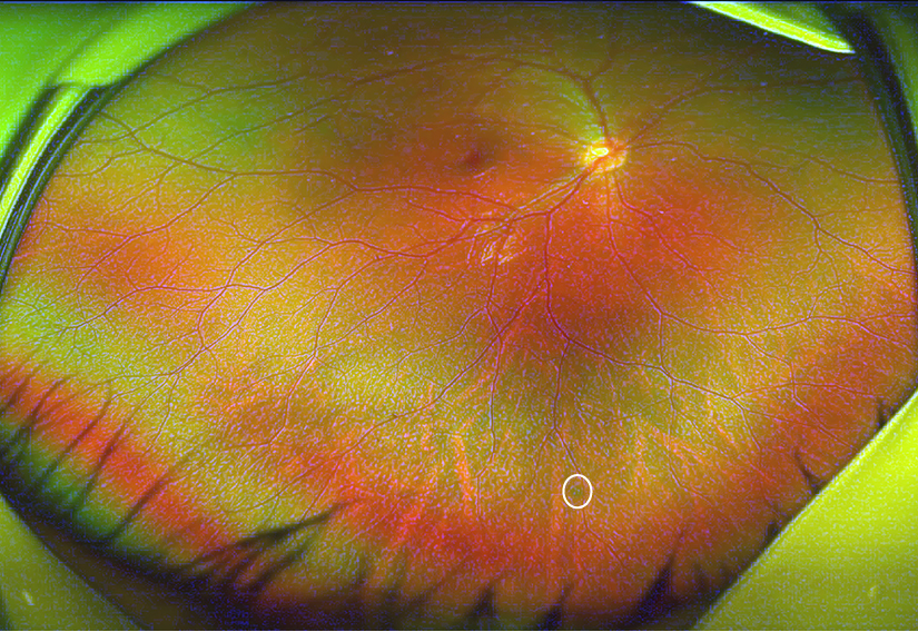 周边部视网膜变性的超广角激光眼底照相表现(白箭头示视网膜萎缩孔)