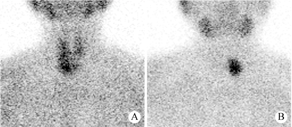 高频超声联合放射性核素对原发性甲状旁腺功能亢进的术前诊断价值